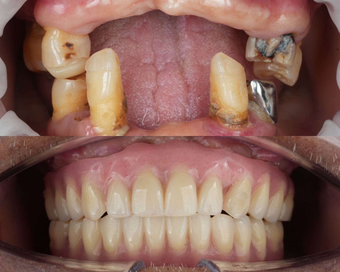 ภาพในช่องปาก — ก่อนและหลังการใส่ All-on-4