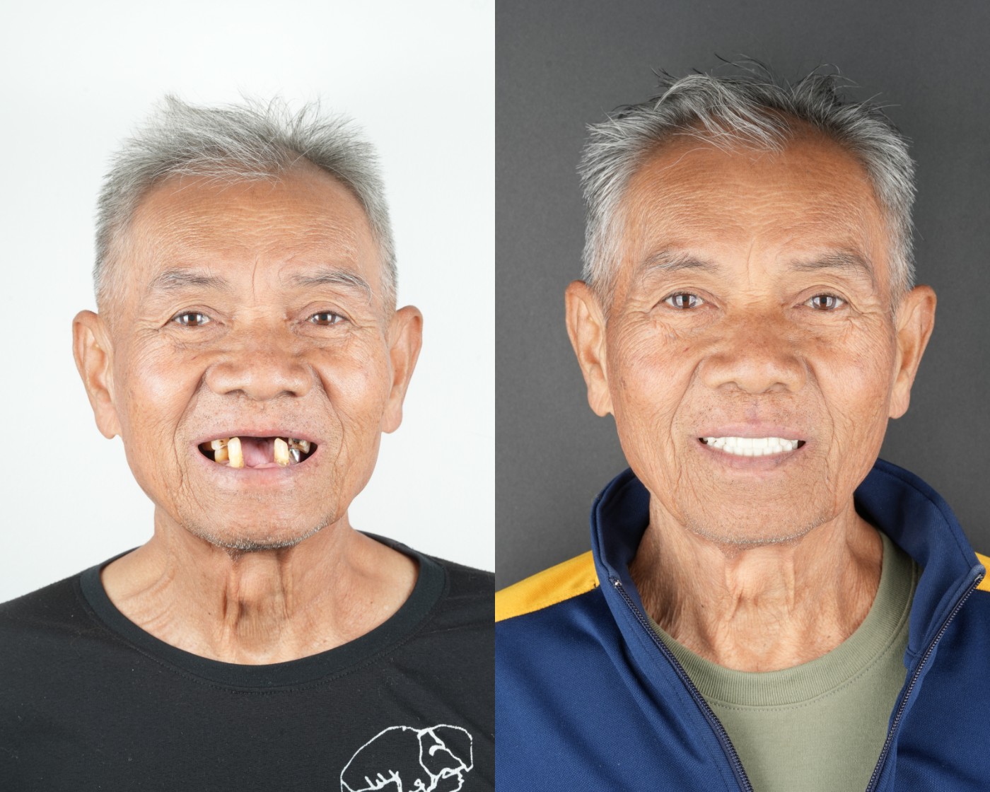 Case 01 — All-on-4 บนล่าง