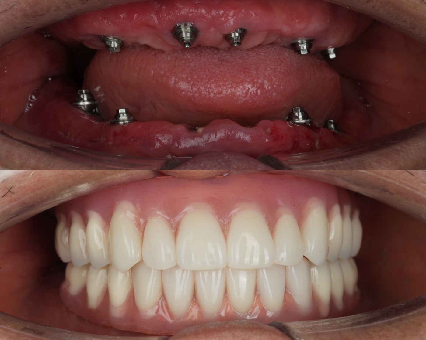 ภาพในช่องปาก — หลักยึดรากเทียมและสะพานฟันถาวร