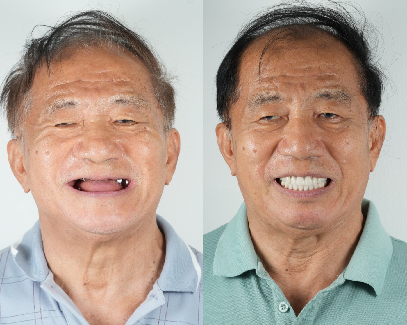 Case 02 — All-on-6 Upgrade