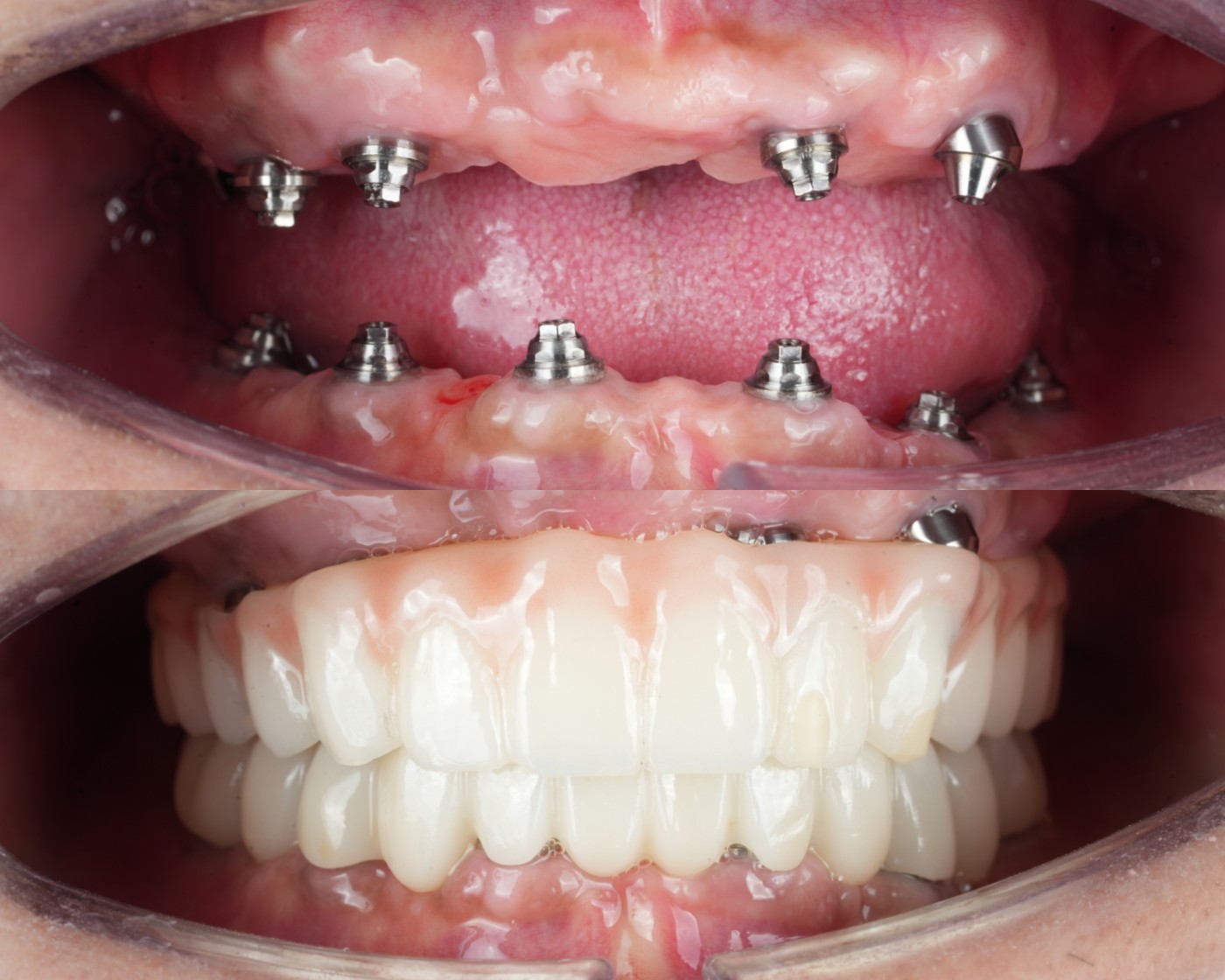 ภาพในช่องปาก — หลักยึดรากเทียมและสะพาน Zirconia