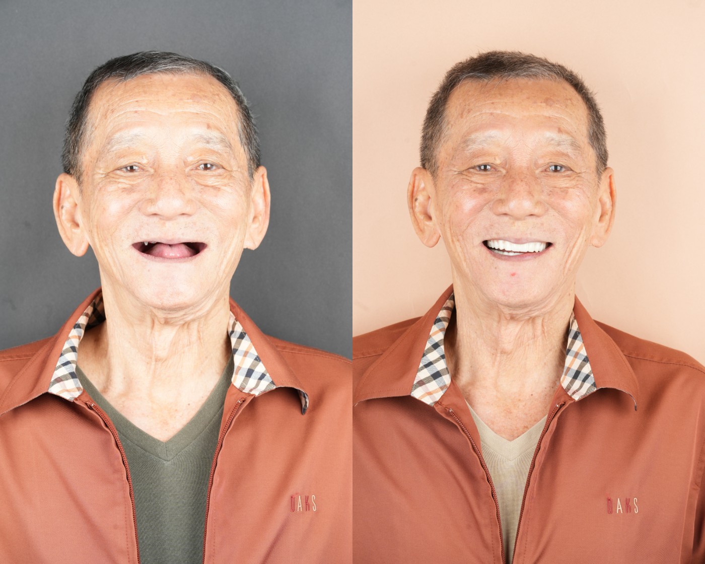 Case 03 — All-on-6 Zirconia